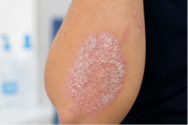 Plaque Psoriasis (Psoriasis Vulgaris)
