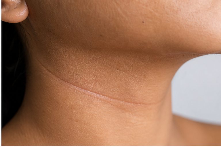 Surgical & Traumatic Scars