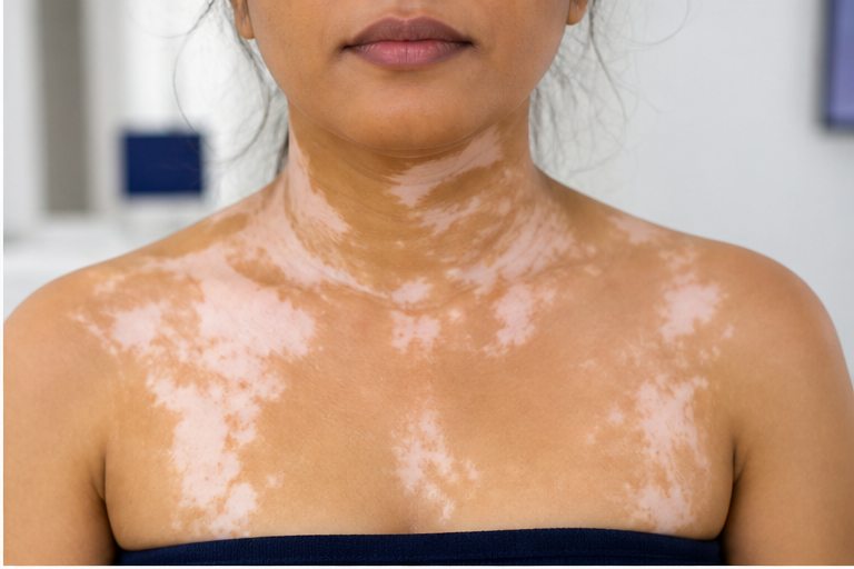 Generalized Vitiligo