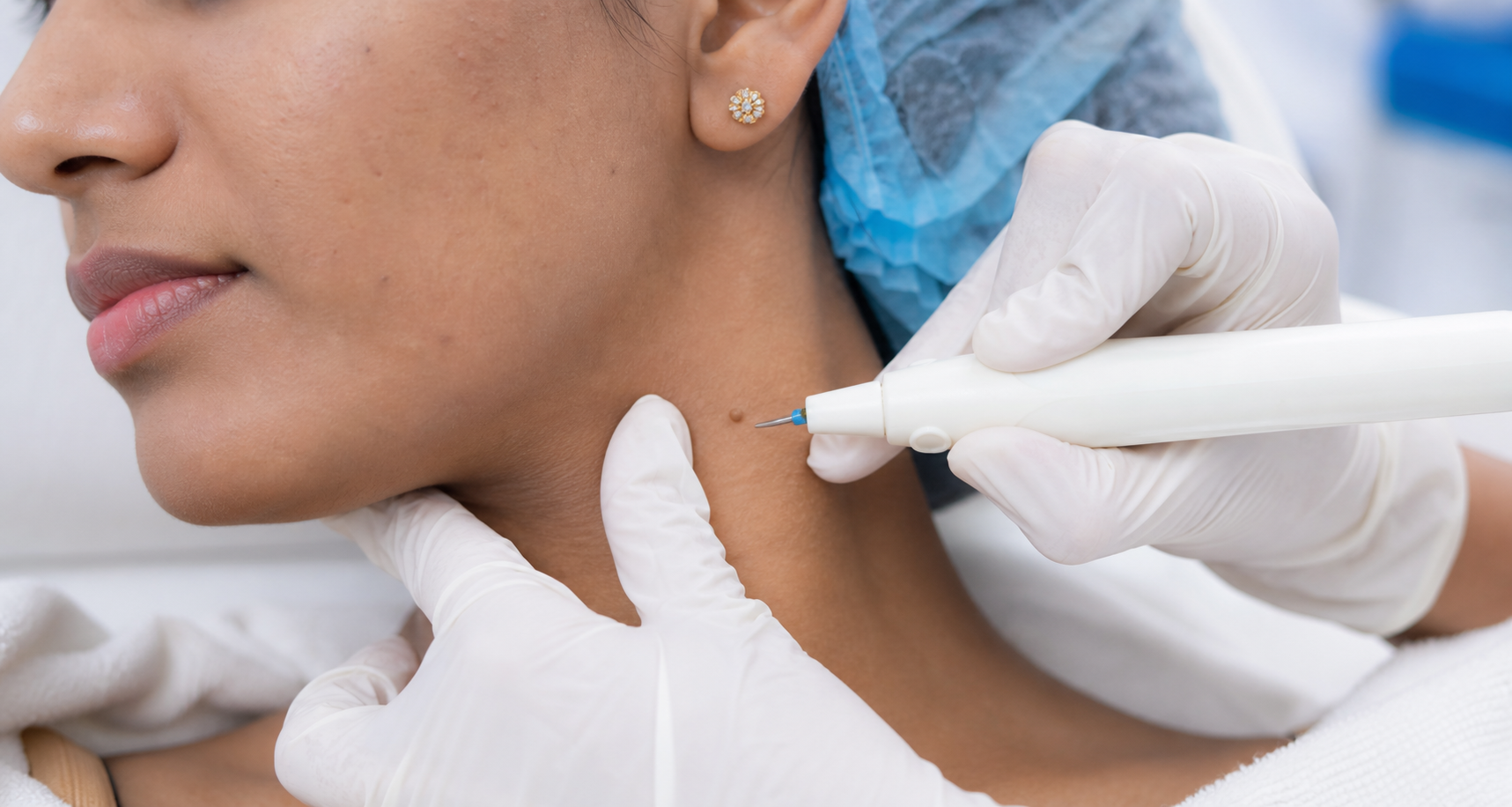 Radiofrequency Treatment